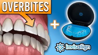 Can Invisalign FIX Overbites amp Other Bite Problems  Premier Orthodontics [upl. by Timothee632]