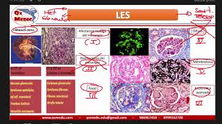 REUMATO  Lupus Eritematoso Sistematico [upl. by Doroteya]