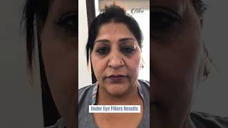 Under eye filler before and after  Dr Shikha Aggarwal  Dermal Fillers Treatment in Ludhiana [upl. by Sinnard]