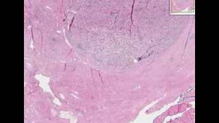 Histopathology ProstateAdenocarcinoma [upl. by Aitahs]