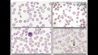 All you need to know about Schistocytes [upl. by Neel]