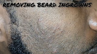 Removing Ingrown Hairs on My Mans Beard [upl. by Daniyal]