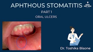 Aphthous stomatitis  Part 1  Oral ulcers [upl. by Aropizt]