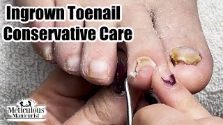 Learn How to Pedicure at Home with Conservative Care [upl. by Asenav]