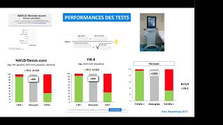 Stéatose Hépatique Non Alcoolique  NASH  NAFLD [upl. by Sothena457]