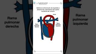 Conducto arterioso persistente [upl. by Er]