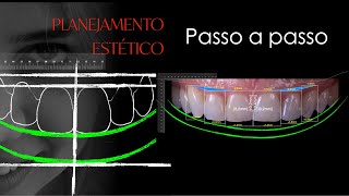 Planejamento Estético Caso Clínico de Resinas em Dentes Anteriores [upl. by Acsirp]