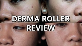 EFFECTIVE ACNE SCAR REMOVER  DermaRoller Philippines Review [upl. by Halivah]