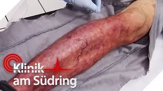 Muss das Bein amputiert werden Es verfault  FreddyFreitag  Klinik am Südring  SAT1 TV [upl. by Arinaid]