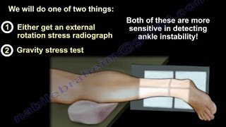 Ankle Fracture  Stress View Radiographs  Everything You Need To Know  Dr Nabil Ebraheim [upl. by Ardnekan]