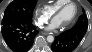 constrictive pericarditis [upl. by Korella]