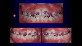 Fixed Orthodontic Appliances in the Mixed Dentition [upl. by Ennyrb]