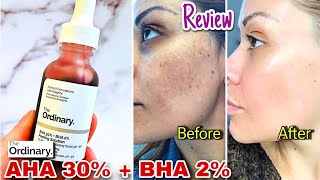 The Ordinary AHA BHA Peeling Solution Review  MAGIC in a Bottle🤔 [upl. by Misa]