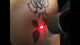 PicoSure Laser Tattoo Removal  UnTattooU [upl. by Carew]