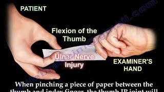 Froments Sign  Everything You Need To Know  Dr Nabil Ebraheim [upl. by Editha]