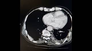 Adenocarcinoma of left lung with extrathoracic and intraspinal extension [upl. by Siuqram]