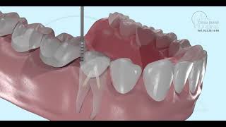 Endodontie und tiefe Hohlräume 3D Was es ist und wie es gemacht wird 3D [upl. by Engapmahc534]