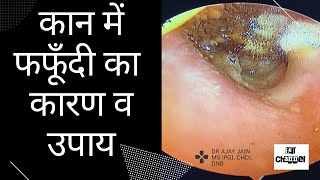 Otomycosis। कान में फफूँदी लगना। Fungal infection in ear। कारण व ईलाज। [upl. by Schulein]