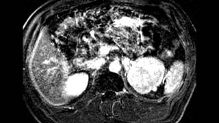 Paraganglioma [upl. by Dinnie687]