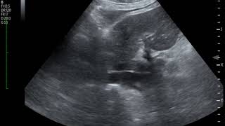 Thrombus in IVC Ultrasound JETem 2018 [upl. by Odiug577]