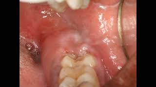 Operculectomy procedure with blade Painful swollen gum around wisdom tooth Pericoronitis Treatment [upl. by Linson634]