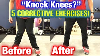 quotKnock Kneesquot Genu Valgum 5 BEST CORRECTIVE EXERCISES  Dr Wil amp Dr K [upl. by Olnek413]