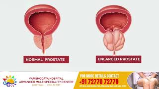 Understanding Frequent Micturition Dr Somashekar  Vamshodaya Hospitals [upl. by Koehler570]