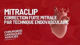 Mitraclip  Correction fuite mitrale par technique endovasculaire [upl. by Othilie]