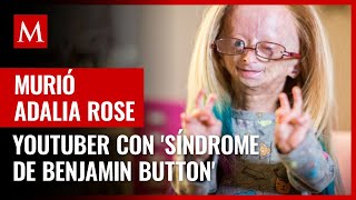 Murió Adalia Rose youtuber con el síndrome de Benjamin Button a los 15 años [upl. by Esli]