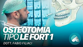 Chirurgia ortognatica  Osteotomia tipo Le Fort I [upl. by Ardnossak]