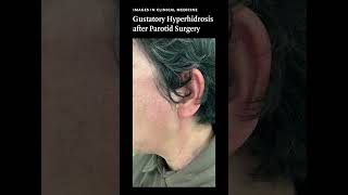 Images in Clinical Medicine Gustatory Hyperhidrosis after Parotid Surgery [upl. by Ohnuj]