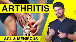 Arthritis After ACL Reconstruction and Meniscus Repair I Full information [upl. by Pooi378]