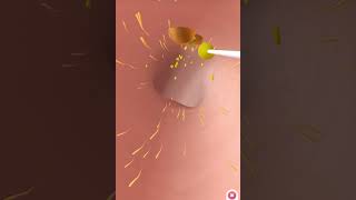 Ear wax removal 👂animation yourbody satisfying relaxing earwaxremoval hygiene [upl. by Mullen]