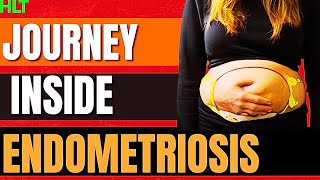 Endometriosis Causes Symptoms and stages [upl. by Aidul]