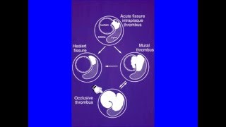 ISTH Academy Presentation Arterial Thrombosis Pathogenesis Epidemiology [upl. by Stoneham]