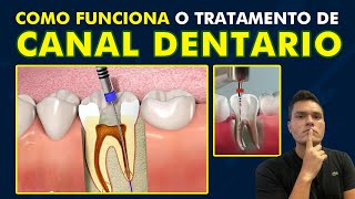 COMO FUNCIONA O TRATAMENTO DE CANAL DENTÁRIO  PASSO A PASSO RESUMIDO [upl. by Thais932]