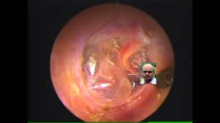 Retracted ear drum seen bulging on valsalva [upl. by Peedsaj]