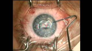 Victus Femto Lasik flap lift by Jeffrey Whitman MD [upl. by Hirasuna]