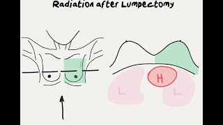 Doctor Explains Radiation After Lumpectomy for Breast Cancer [upl. by Gastineau]