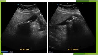 Lithiase vésiculaire en échographie le piège des gaz digestifs [upl. by Warenne464]