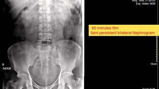 CASE 109 IVP bilateral Delayed faint persistent nephrogram [upl. by Soph]