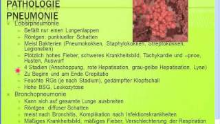 Gratis Seminar Pneumonien  Typische  atypische Pneumonien [upl. by Michaele684]