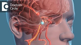 What is the recovery time for Brain Aneurysm  Dr Tejus MN Rao [upl. by Torosian516]