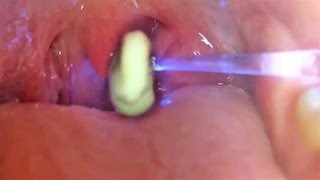 Worlds Greatest Tonsil Stone Removals 2 [upl. by Joslyn]