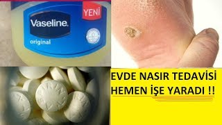 EVDE NASIR TEDAVİSİ KESİNLİKLE İŞE YARAYAN YÖNTEM [upl. by Bunde]