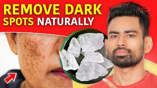 How to Remove Dark Spots and Get Clear Skin Pigmentation Dark Underarms Acne scars amp more [upl. by Sheya673]