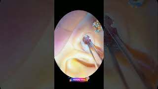 Earwax removal Part 43 [upl. by Adehsar962]