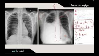 Pneumothorax vs Pleural effusion [upl. by Uda]