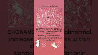 Placental pathology CHORANGIOSIS [upl. by Dola330]