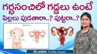 Understanding Uterine Fibroids Causes Symptoms and Treatment Options  Uterine Fibroids  Ferty9 [upl. by Mobley]